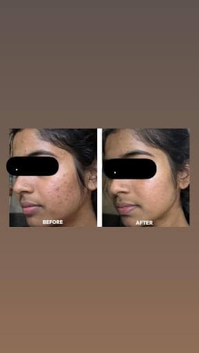 Before and after acne treatment result