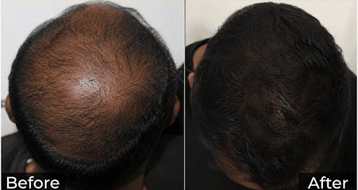Before and after hair GFC therapy result